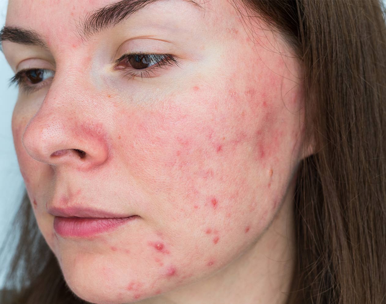 Vaskularne manifestacije na koži